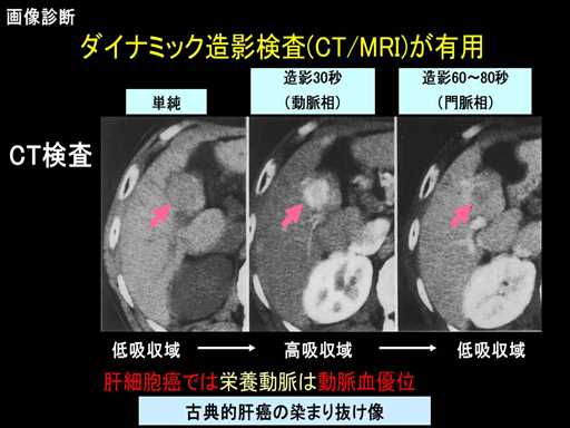 XCh摜