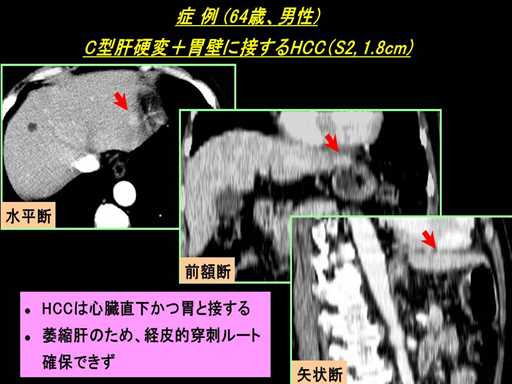 XCh摜