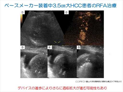 XCh摜